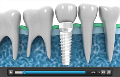 Dental Implants Chicago Cosmetic Dentist